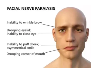 facial paralysis