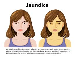 jaundice